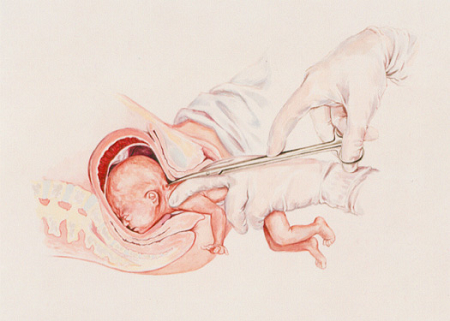 partial-birth-abortion